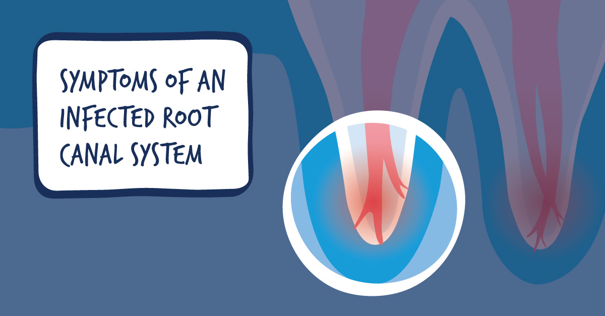 Do I need a root canal?