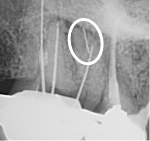 Separated Instrument