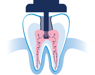 GentleWave Procedure Illustration