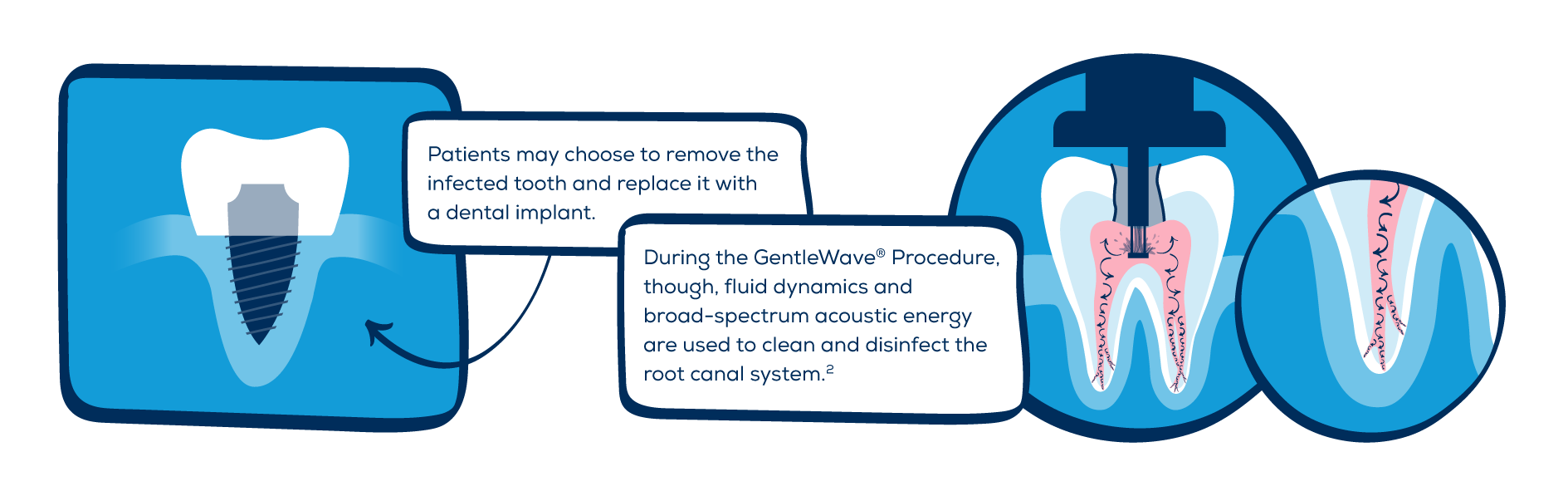 Root canal treatment options