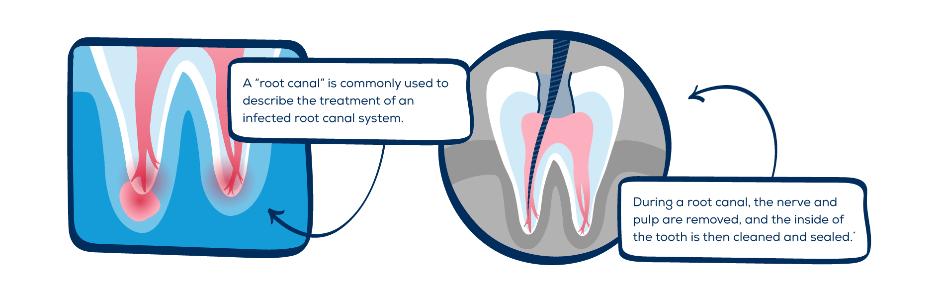 what is a root canal