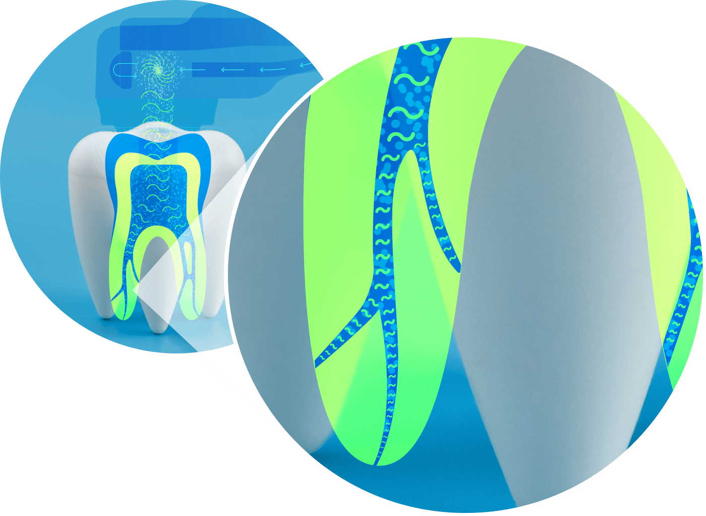 GentleWave Procedure