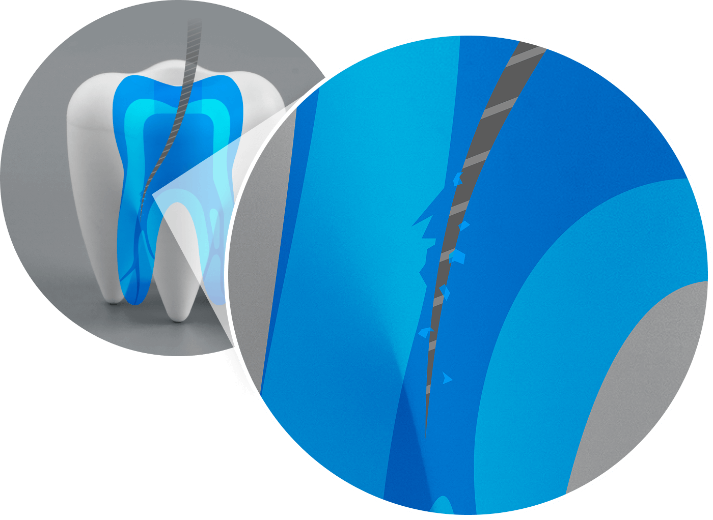 Standard Root Canal Treatment