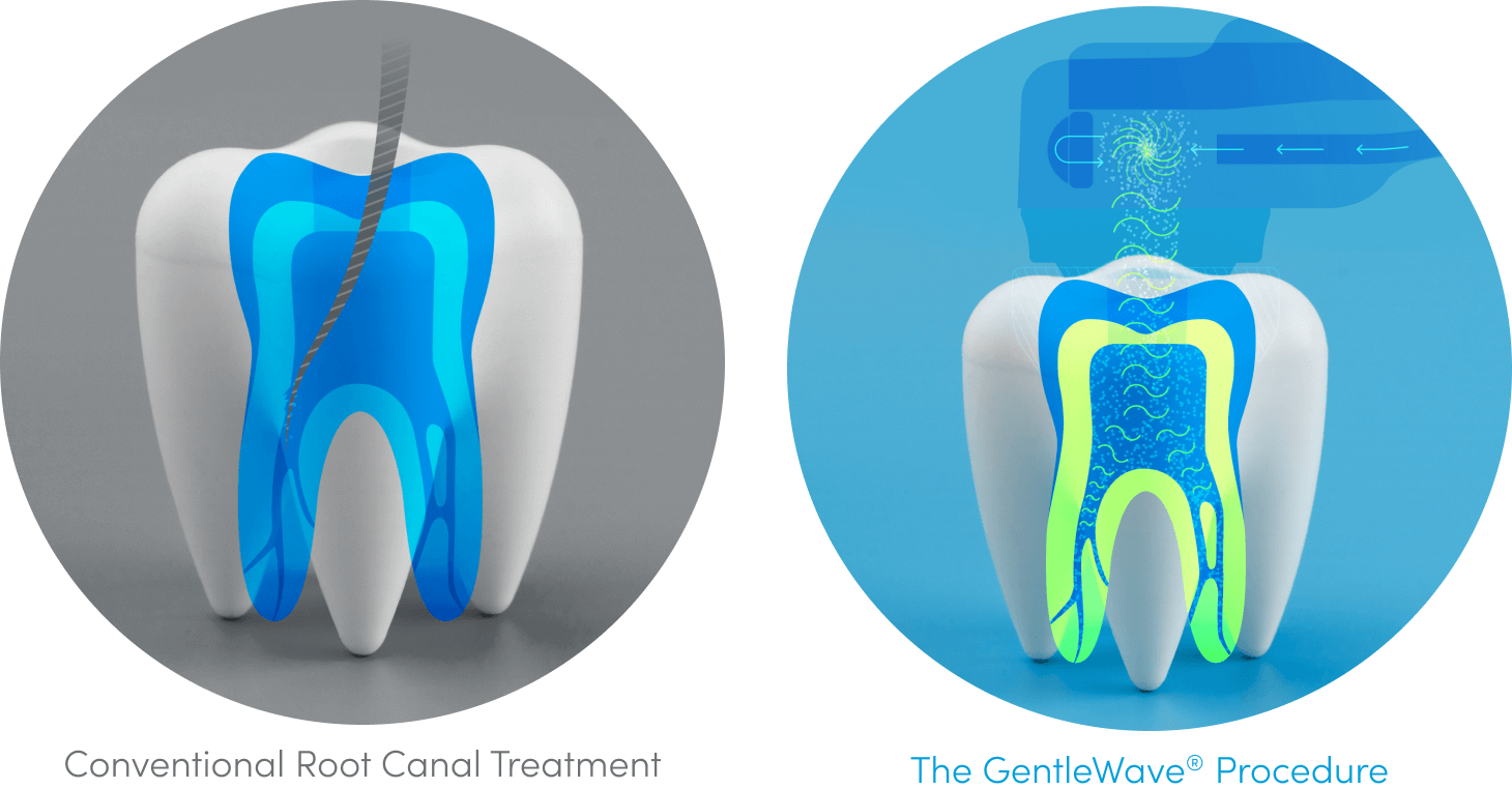 Root Canal Therapy Options