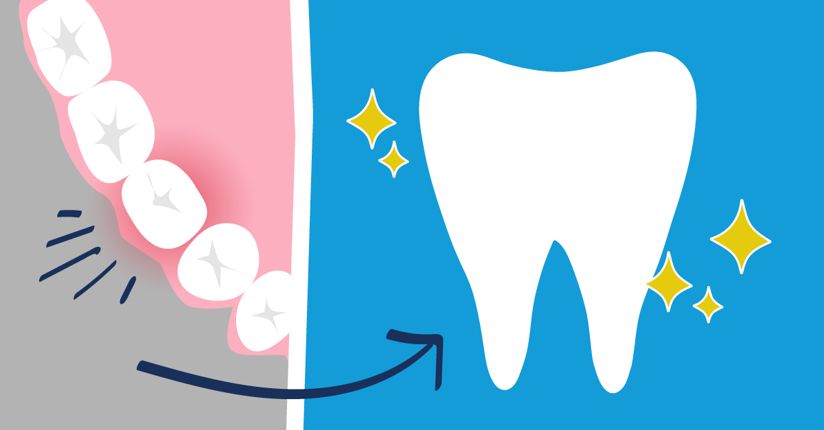 What You Can Expect from Your Root Canal Treatment