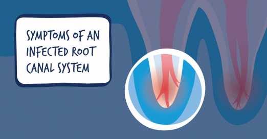 Do I Need a Root Canal? Possible Signs and Symptoms