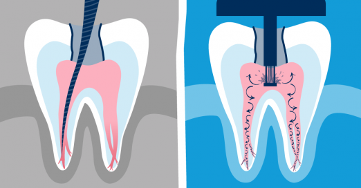 Comparing Treatments | Standard RCT vs. The GentleWave Procedure