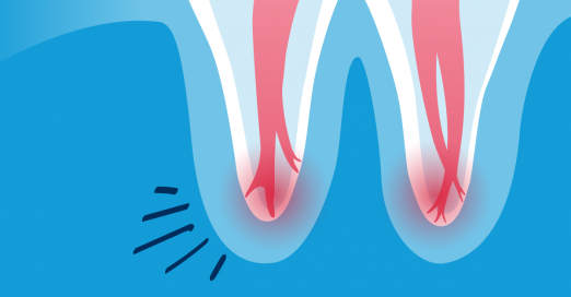 root canal system infection