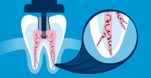 root canal dental implant 