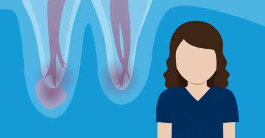 What to Know About Root Canals