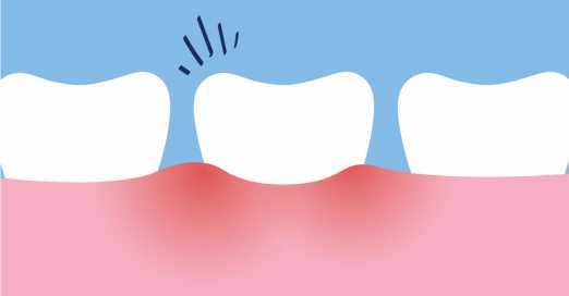 Pulpitis & Root Canal System Infections in Wisdom Teeth