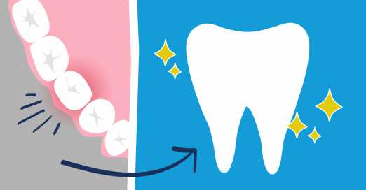 What You Can Expect from Your Root Canal Treatment