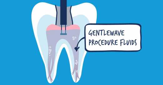 root canal alternative