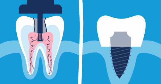 alternative to root canal | GentleWave Procedure 